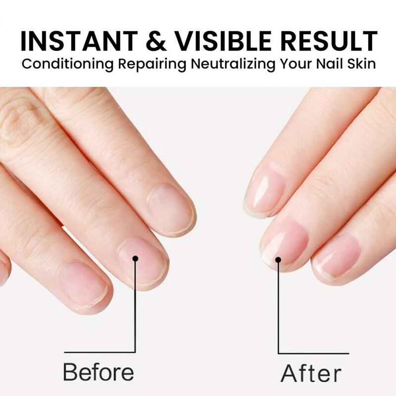 Onychomycosis Nail Treatment Fast-acting 15ml Nail Strengthening Cuticle Oil Repair Damaged Nails Moisturize Cuticles Enhance