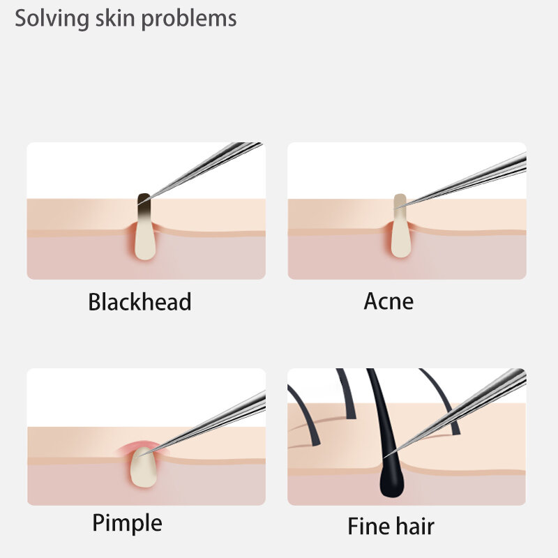 Aghi per la rimozione dei punti neri dell'acne acciaio inossidabile macchia nera rimozione dei brufoli ago strumento per la pulizia profonda Kit per la cura della pelle del viso