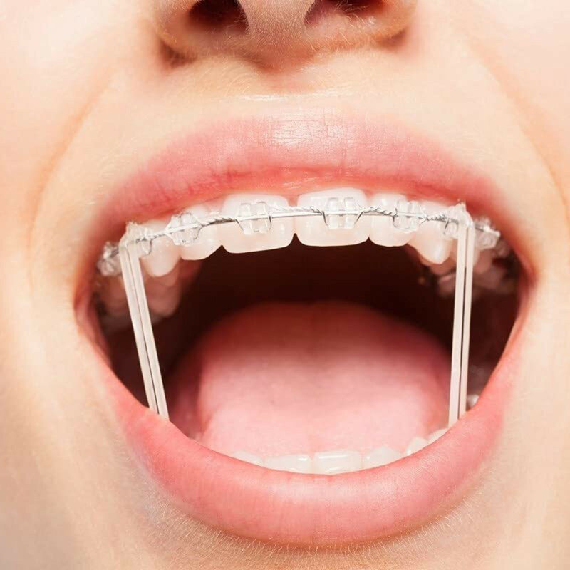100 pezzi elastici per la cura dei denti elastici per denti bretelle correzione dei denti deformità 3.5 Oz 3/8