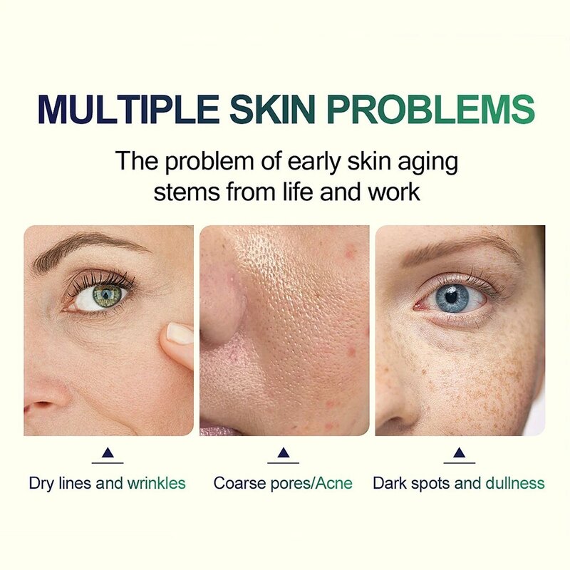 Suero para tratamiento de cicatrices y acné, producto químico Peel 70%, neutralizador de ácido, blanqueamiento de la piel, superfuerza, pigmentación, 30ml