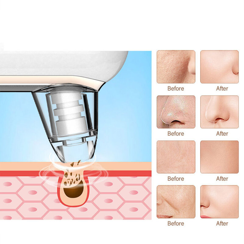 2 ABS Portable Blackhead Remover Vacuum For Easy Operation ABS Made Pore Cleaner Facial Light Weight
