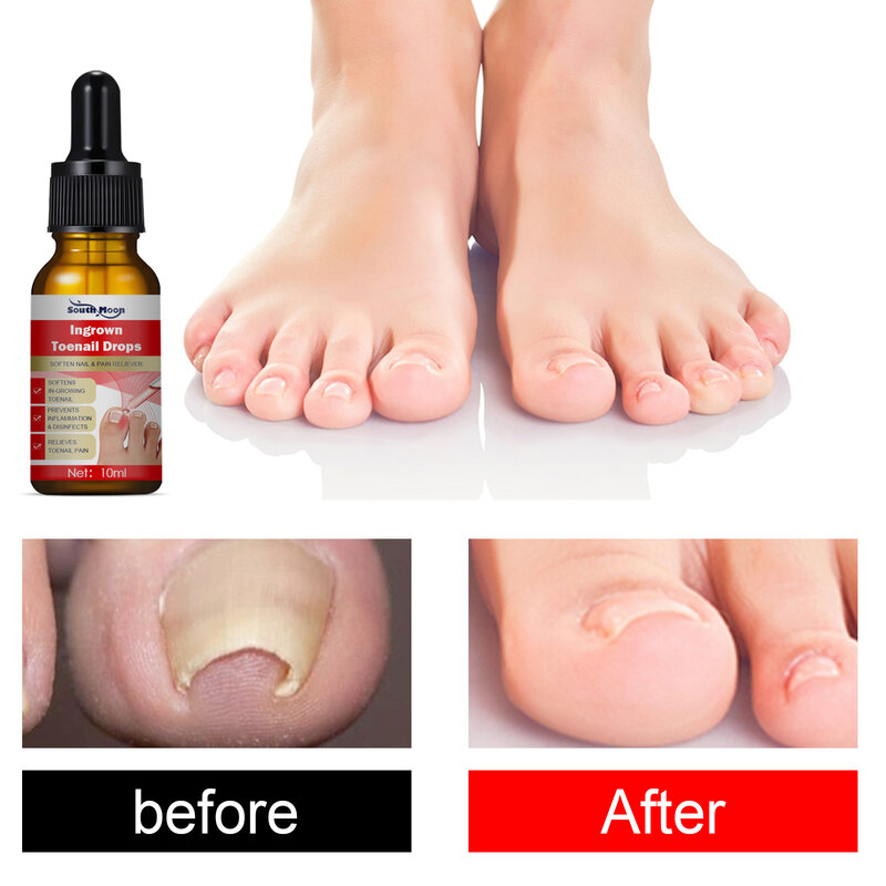 Foot Care Tool Inner Nail Repair Essence Pedicure Nail Whitening Anti-fungal Essential Oil