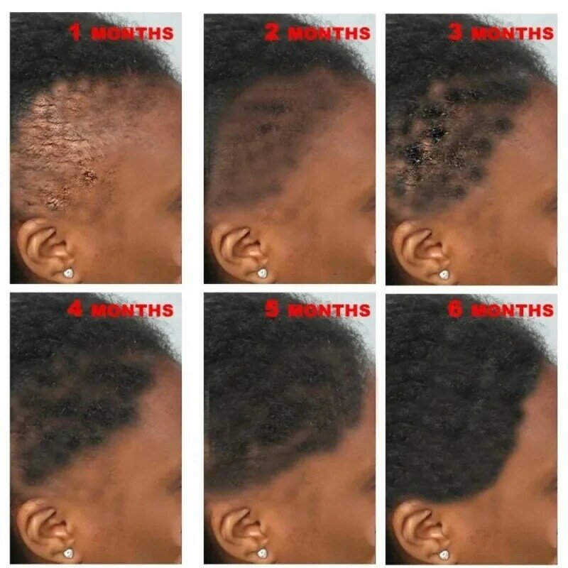 Óleo africano produtos para o crescimento do cabelo para homens e mulheres, alopecia tração, prevenir o crescimento rápido, cuidados do couro cabeludo
