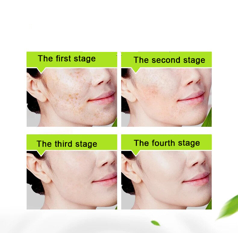 10 DAYS YOUMEI Freckles Removal Day & Night Cream Remove Dark Spots Pigment Skin Care