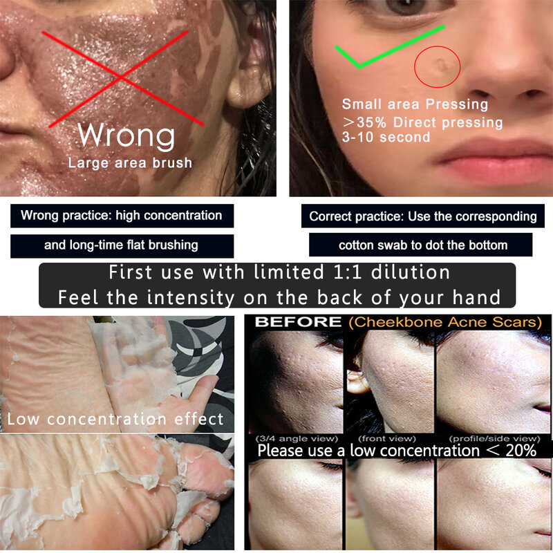 TCA 20% 30% 35% 40% 50% 60% 70% czysty roztwór skórki TCA do uszkodzenia przez słońce drobne linie zmarszczki skóra bez blasku nierówne odcień skóry powiększone