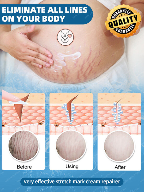 Cream For Pregnancy Stretch Marks Removal Eliminate Red White Old Stretch Marks Oil