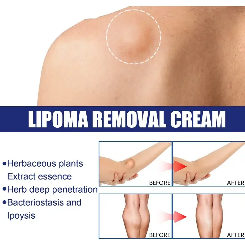 Lipoma Verwijdering Zalf Cellulitis Behandeling Fibroom Remover Subcutane Knobbels Meerdere Lipomen Vetmassa Medicijnen Crème 20G