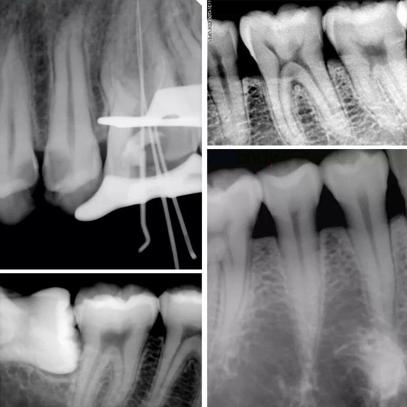 Système d'imagerie intra-orale pratique HDR-500, capteur dentaire numérique pratique, capteur Xray dentaire à rayons X