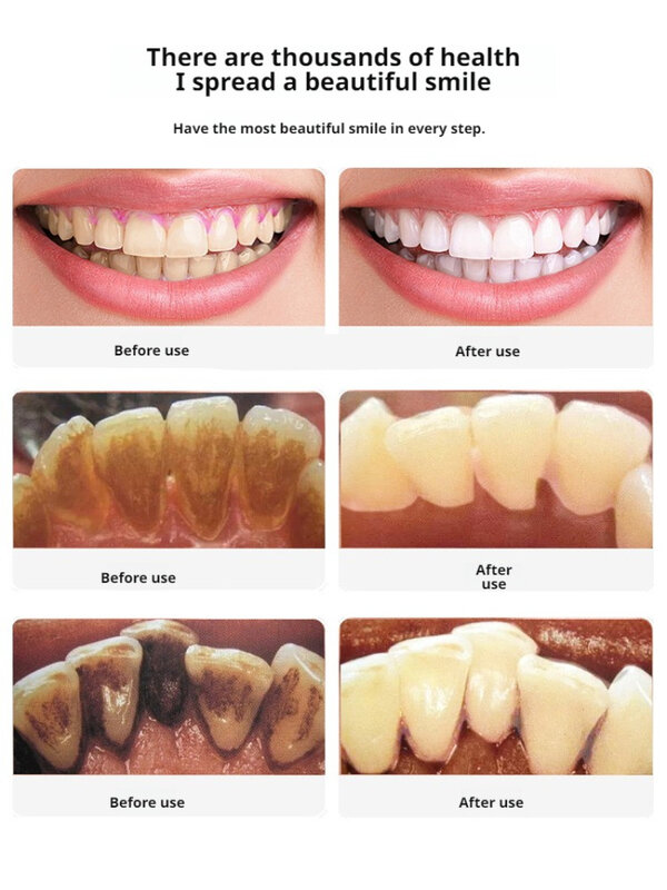 Haushalts zahn reiniger Ultraschall Zahn reiniger Zahnpflege Mundgeruch Reinigung Zahn reiniger