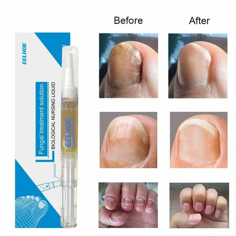 Trattamento antimicotico per unghie cura della pelle delle dita trattamento dei funghi delle unghie soluzione di riparazione della penna liquida olio nutriente ripristina sano