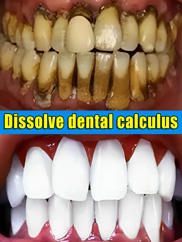 Disolución para eliminar el cálculo dental
