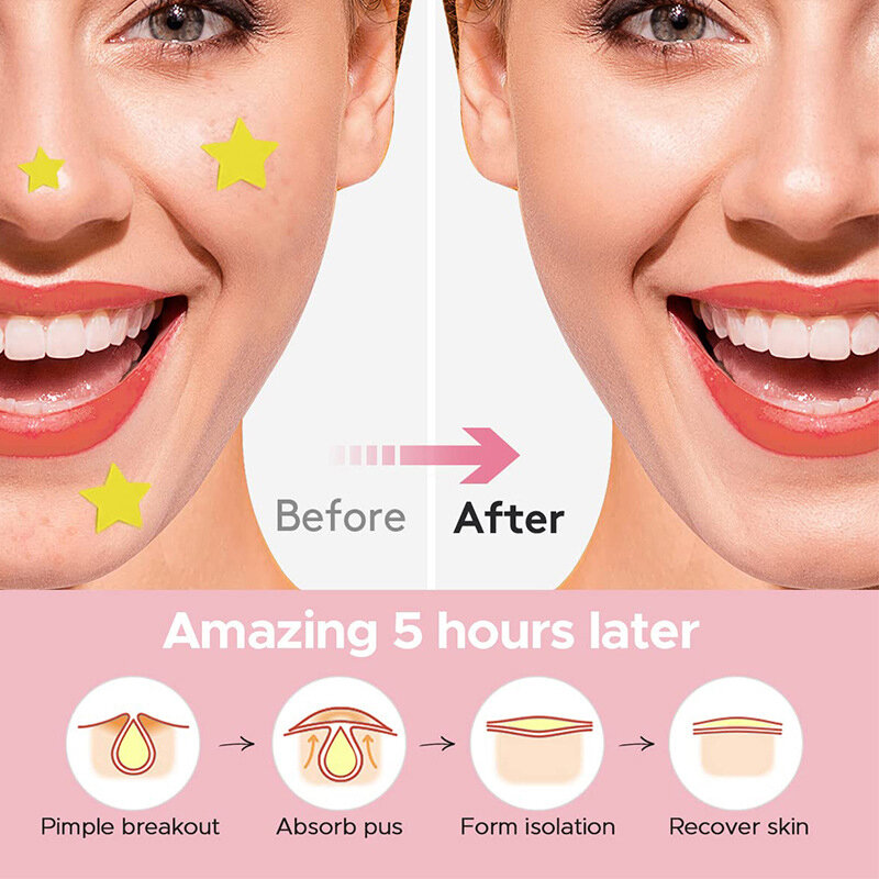 Star Pimple Patch para Remoção de Acne, Adesivos de Cuidados Com A Pele, Corretivo, Face Spot, Ferramentas De Maquiagem De Beleza, Colorido, Remoção Invisível, 600 PCs por Conjunto