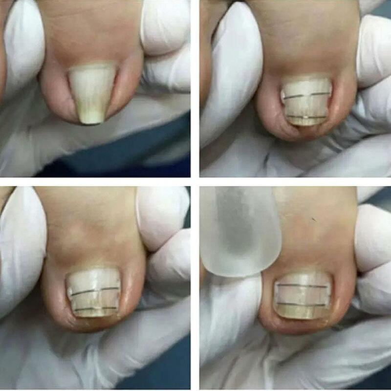 Strumenti per il correttore dell'unghia del piede Pedicure recupera il trattamento per unghie dei piedi incorporato tutore per Clip lisciante per unghie incarnite professionale