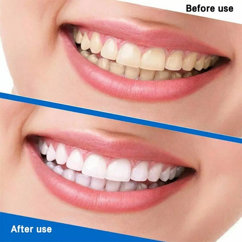 100g reparação de cavidades cárie reparação dentes manchas de placa decaimento clareamento amarelecimento reparação dentes clareamento