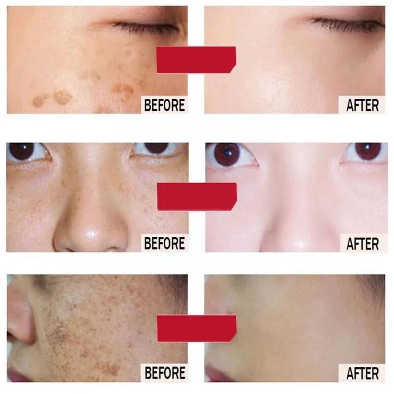 Whitening Freckle Face Cream, remover manchas de acne e manchas escuras, Skin Lift, pele brilhante endurecimento, Face Care, Novo, M5v8, 2023