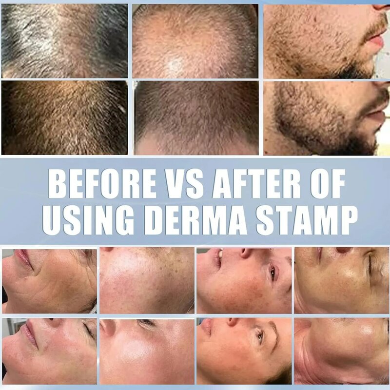 Ajustável Derma Stamp Microneedling, 140 Pin Needles, Face, Body Care, Cabelo, Crescimento da barba