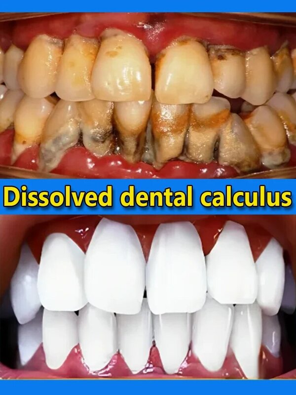 Zahnweiß produkte zur Entfernung von Zahnstein und Zahnstein entferner