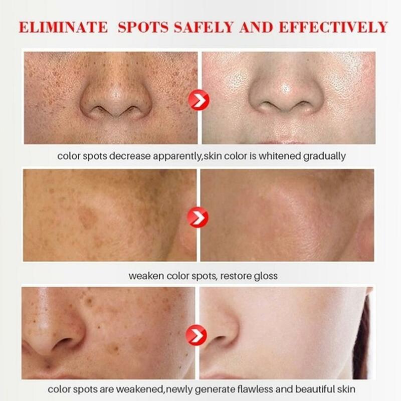 Fade Dark Spot Corrector Skin Lightening Blemish Removal Serum Fade Cream Reduces Age Spots Whitening Freckles Face Cream 20g