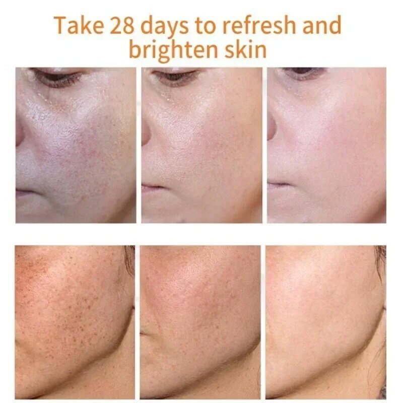 Effective Whiten Freckle Cream Brighten Face Remove Dark Face Spot Melasma Anti-pigmentation Improve Dullness Skin Care Cream