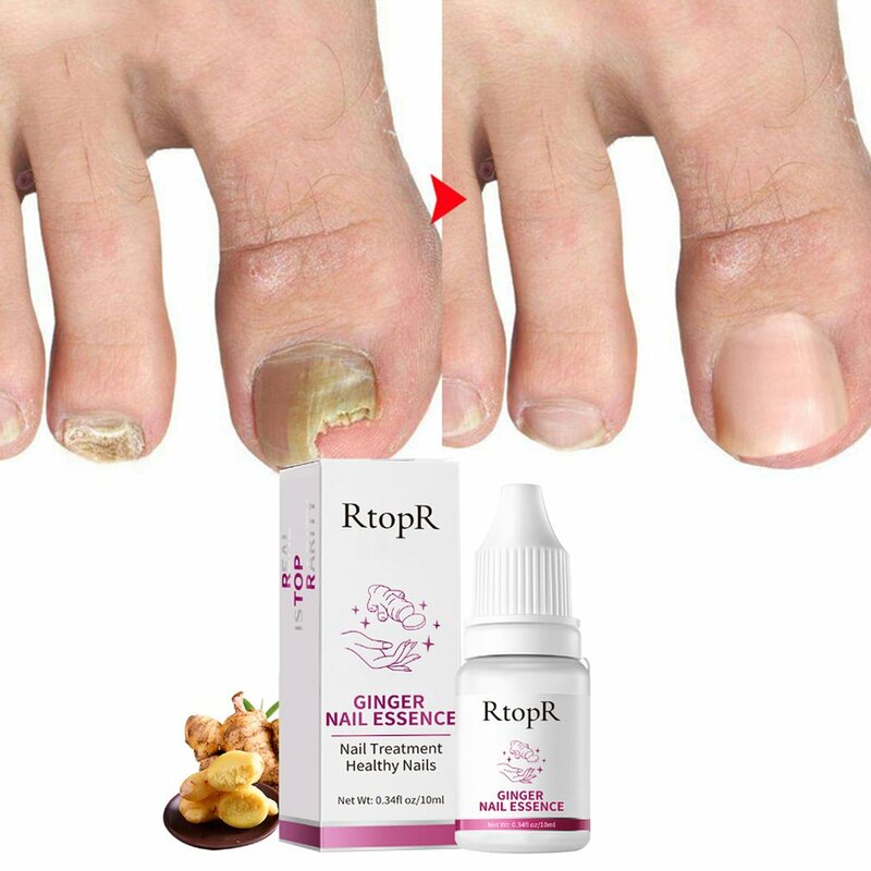 Nail Repair Essence Serum Fungal Nails Treatment Remover Onychomycosis Toe Nourishing Hand Foot Care Liquid Skin Care Tools