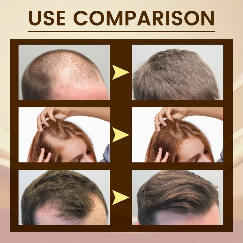 Óleo de crescimento capilar para tratamento do couro cabeludo, reparo da calvície, cabelos secos e danificados, nutrição suave, soro para perda de cabelo seco, tratamento para nutrição