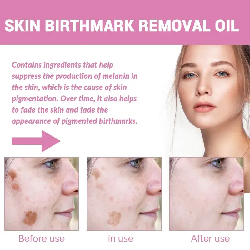 Pele e Birthmark Remoção Soro, Anti Freckle, Pigmentação desvanecer-se, Melasma Hidratante, Clareamento, Clarear Face Care, Essence Oil