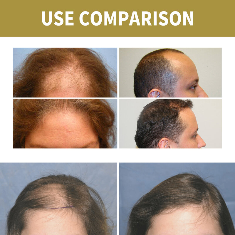 Hair Nutrition Regrowth Spray Hair Growth Treatments Essence Fast Effective Hair Grow Restoration Regeneration Serum Hair Care