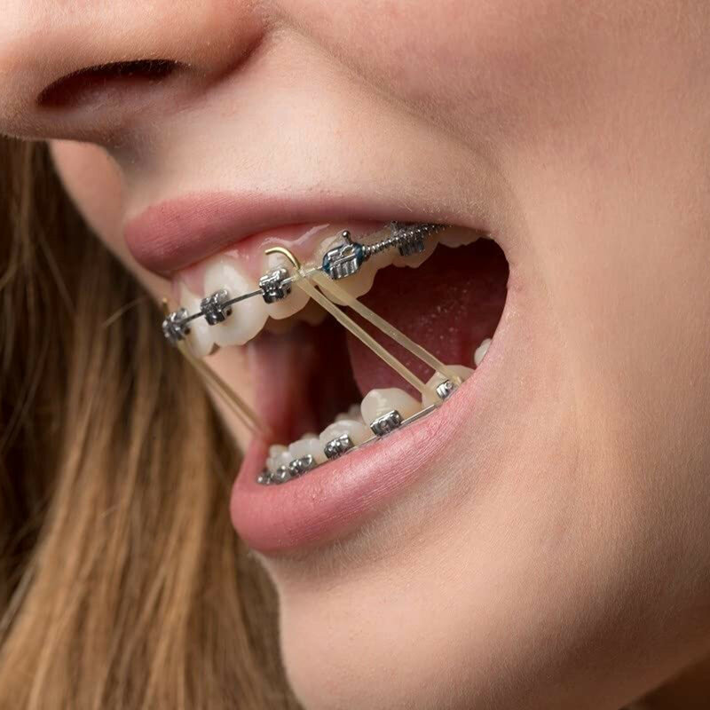 100 Stück Gummibänder für die Zahnpflege Zähne Gummibänder Zahnspangen Korrektur der Deformität 3,5 Unzen