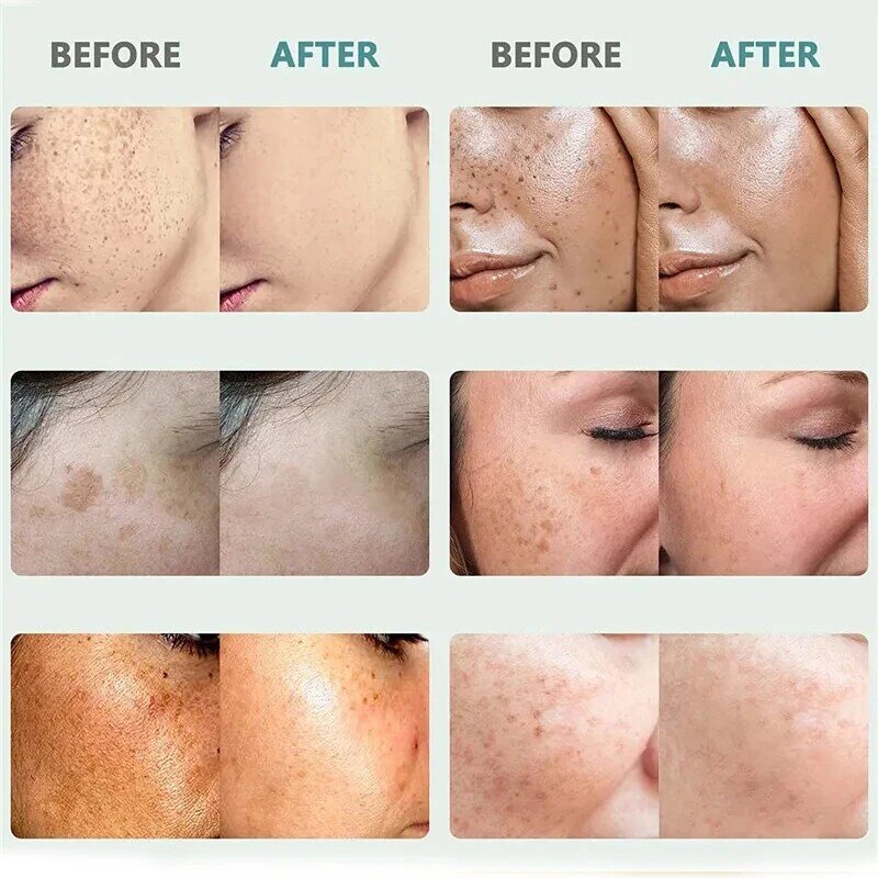 Niacinamide Facial Whitening Serum Removing Melasma Sun Spots Lightening Pigmentation Brightening Moisturizing Skin Care 50ml