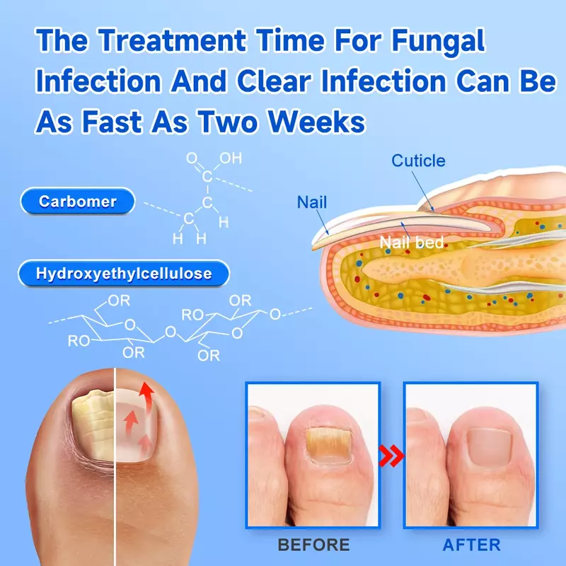 Riparazione delle unghie dispositivo per unghie riparazione rapida unghie fungo onicomicosi per unghie unghie dei piedi paronichia Anti infezione unghie dei piedi