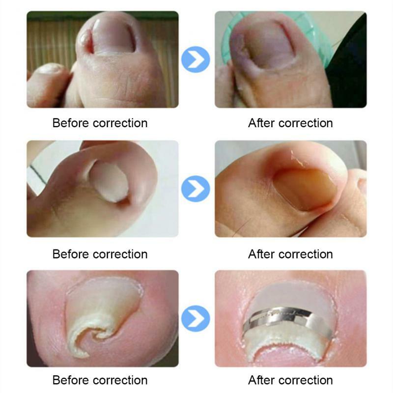 Ein gewachsene Zehennägel Korrektor Edelstahl Nagel glättung werkzeug Linderung Schmerz Pediküre Werkzeug für ein gewachsene Zehen nagel erholen