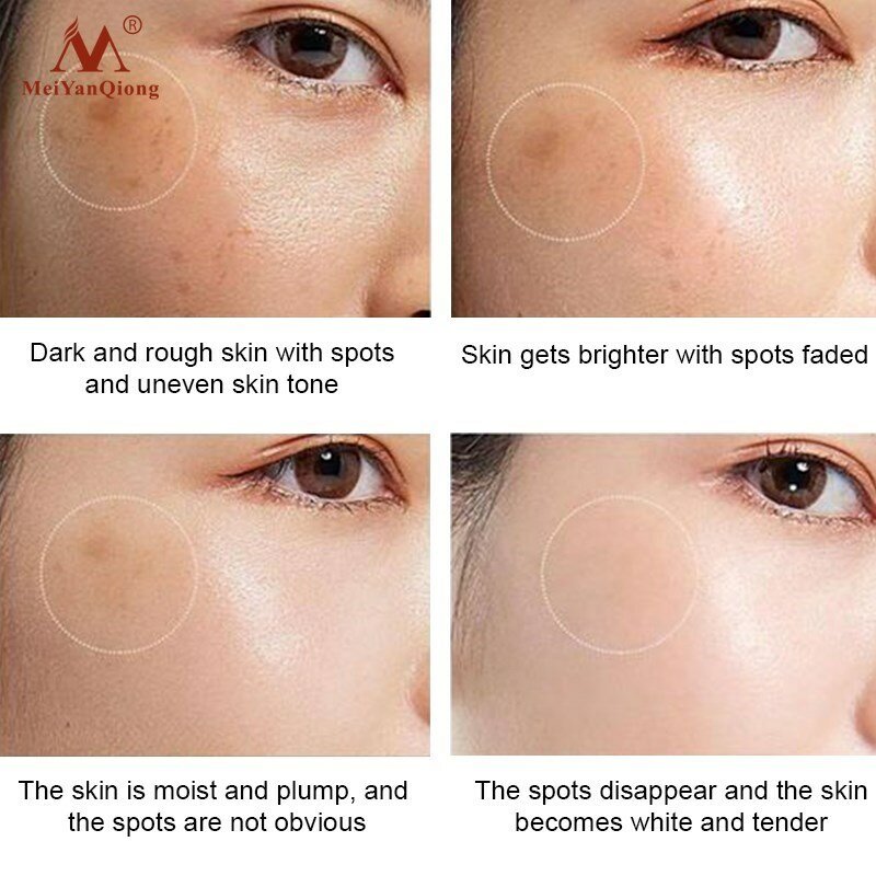 Creme clareador para o rosto, creme hidratante para remover manchas de acne, melanina, manchas escuras, reafirmante, cuidados com a pele, brilhante