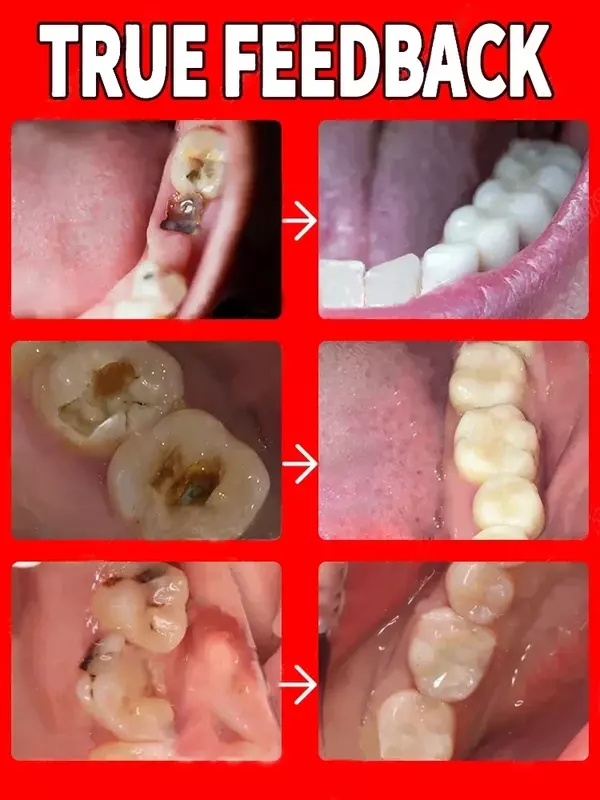 Sbiancamento dei denti alito cattivo fresco rimuovere la placca mal di denti alleviare