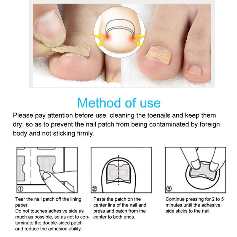Pexmen 10/20/50/100Pcs Ingrown Toenail Correction Sticker Foot Care Kit Ingrown Toenail Corrector Pedicure Tool Toe nail Pads