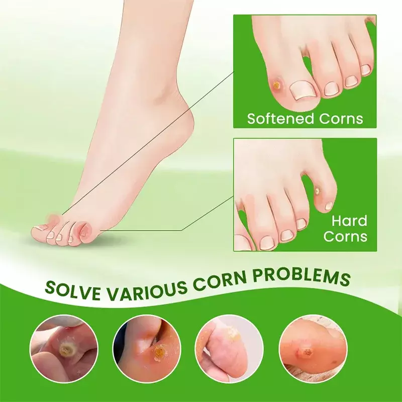 Krem do usuwania kukurydzy stóp Kurczak Oko Leczenie infekcji skóry Maść Stopy Martwa skóra Narzędzie do usuwania modzeli Opieka zdrowotna