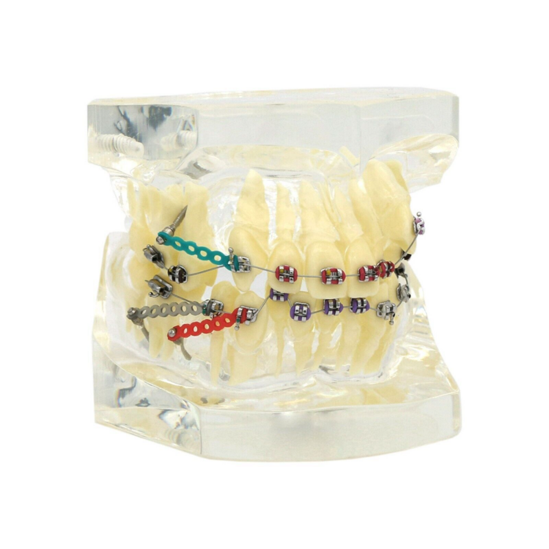 Zahn kieferorthopädie Behandlung Zähne Modell mit Metall klammern Bogen drähte Krawatten zur Demonstration