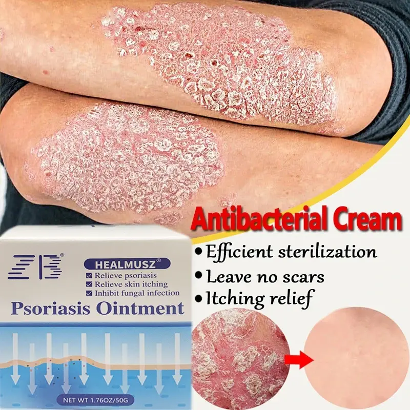 1 Stuk Psoriasis Hydraterende Crème Natuurlijke Reparatie Effectief Antibacteriële Verlichten Exfolie Droge Huid Jeukende Ruwe Huidverzorging