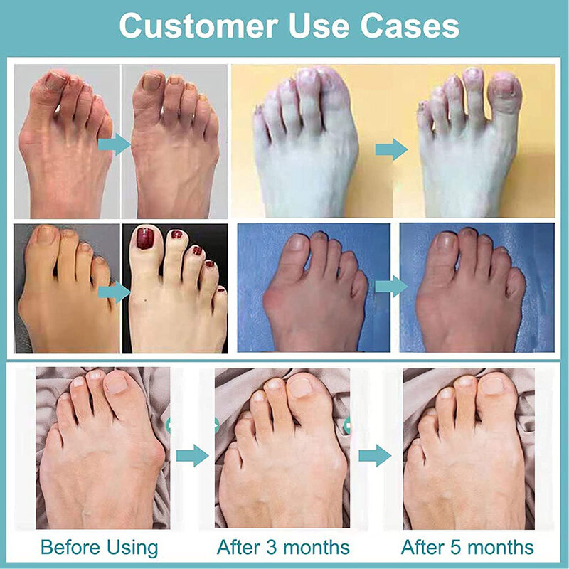 Pexmen 2Pcs/Pair Gel Toe Separator Bunion Bone Ectropion Adjuster Toes Outer Appliance Foot Care Tools Hallux Valgus Corrector