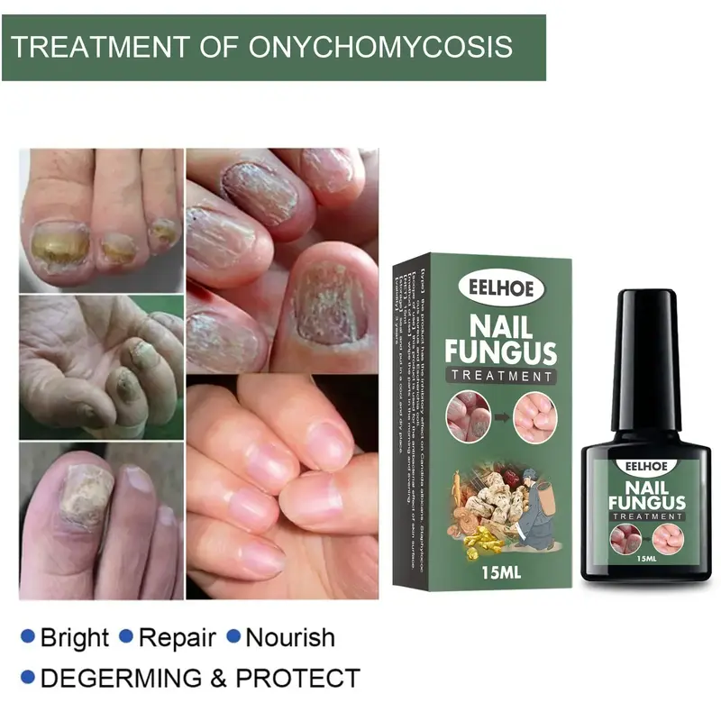 Aceite Esencial para tratamiento de hongos en las uñas, suero para la eliminación de hongos en los pies, 7 días de reparación, onicomicosi, Gel antiinfección, productos para el cuidado