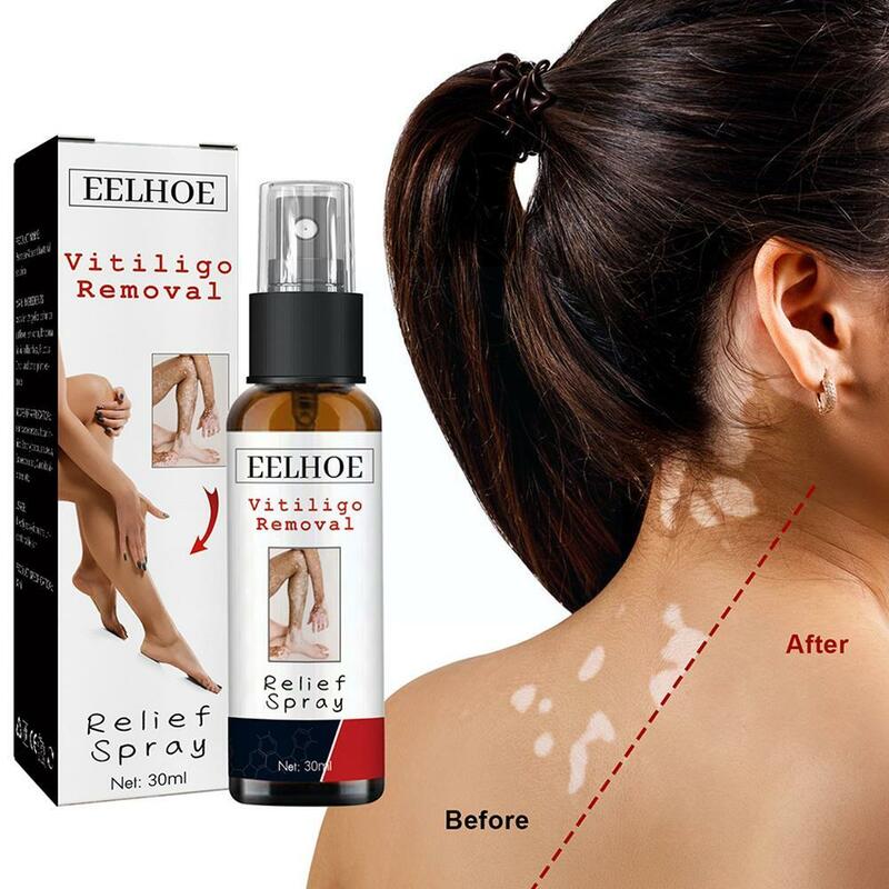 Spray para aliviar el Vitiligo, líquido hidratante para la piel, repara la cara y las manchas del cuerpo, color blanco, R2U4, 30ml