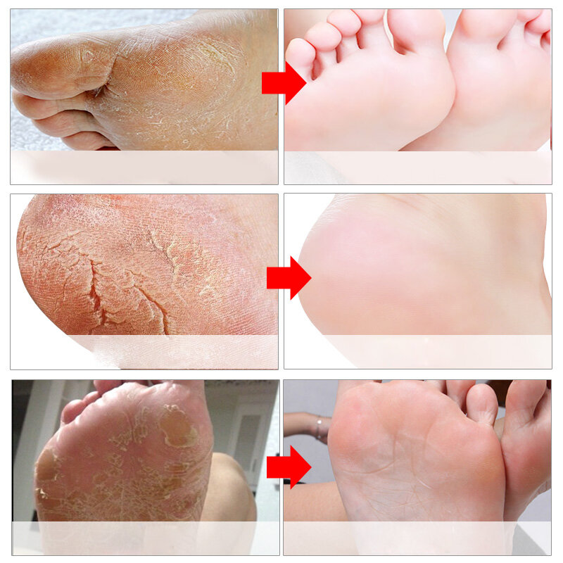 Efero 6/8er Pack Peeling Fuß maske Pediküre Socken Fuß pflaster Bleaching Fuß maske Peel Fuß maske für Beine Peeling abgestorbene Haut