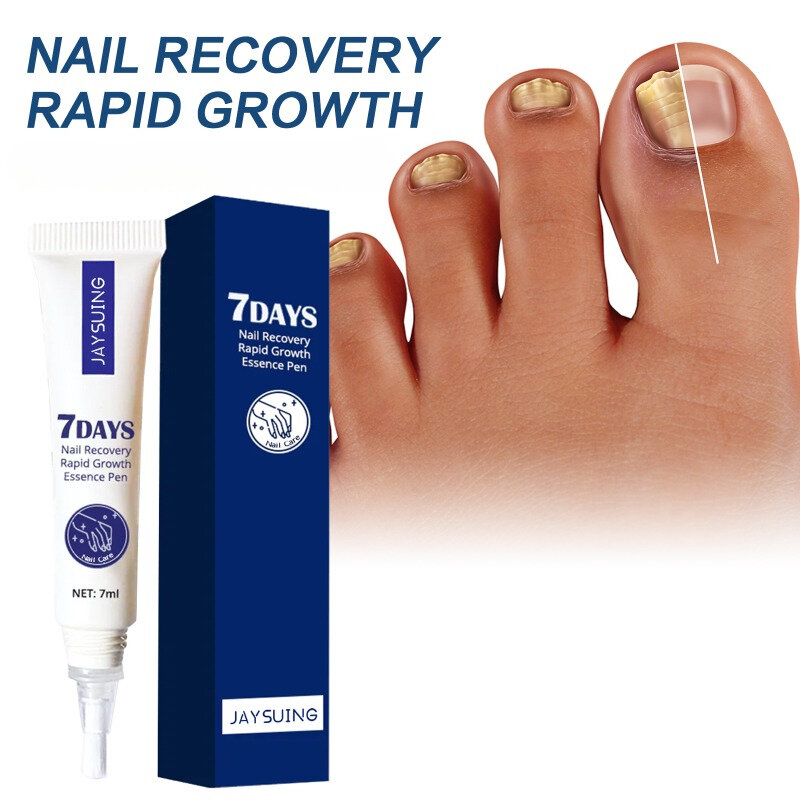 7days nail repair essence hand foot rotten toenails treatment Fungus brightening onychomycosis Anti Infection care solution