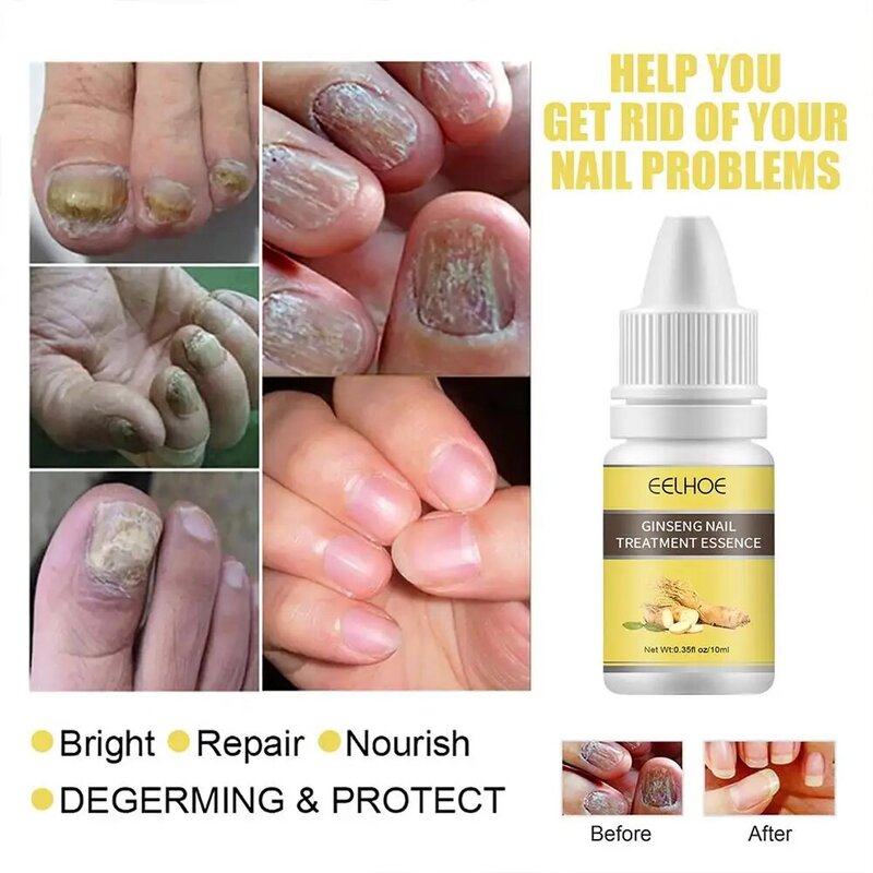 Nail Fungus Removal Cream Onychomycosis Fungal Nail Toe Infection Care Feet Fungal Ointment Treatment Anti Nail Paronychia A1Y9
