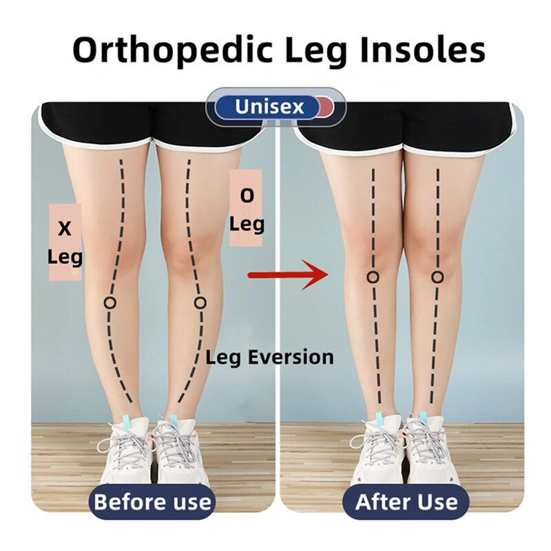 Magnetische orthopädische Silikon-Einlegesohlen für Schuhe, Herren und Damen, Plantarfasziitis-Entlastung, O/X-Beine, Knie, Varus-Korrektur, Füße, Fersenpolster