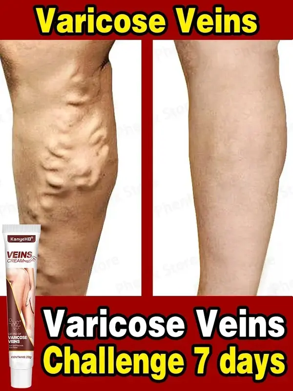 Efficace crema per il sollievo dalle vene Varicose elimina la vasculite flebite trattamento per le gambe del ragno lenitivo alleviare il dolore unguento a base di erbe