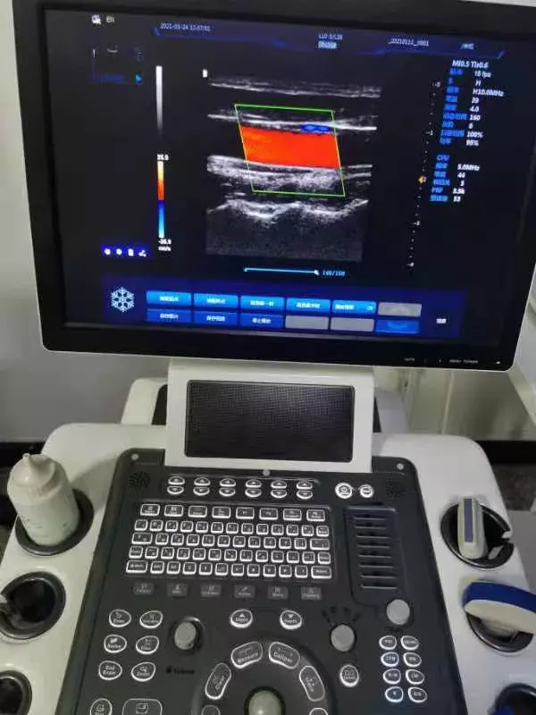 Scanner Ultrassônico Baseado em Carrinho, Scanner Doppler Sonografia, Venda Quente