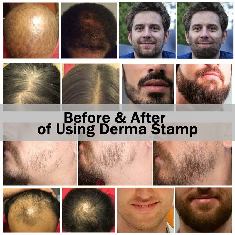 DRS 140A Derma Stamp regulowane mikroigłowanie do twarzy pielęgnacji ciała włosów porost brody do użytku domowego System zwijania Derma