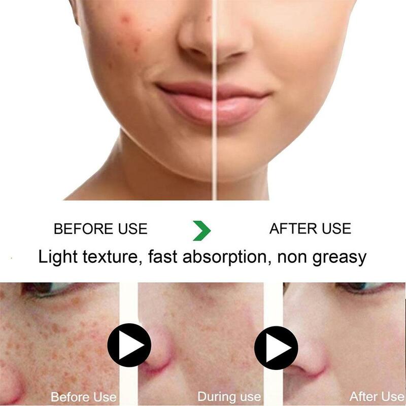 Eficaz Whitening Freckle Cream, Remover manchas escuras, Anti Freckle, Fade Pigmentation, Melasma Iluminar cremes, Cuidados com a pele, 1 a 5X