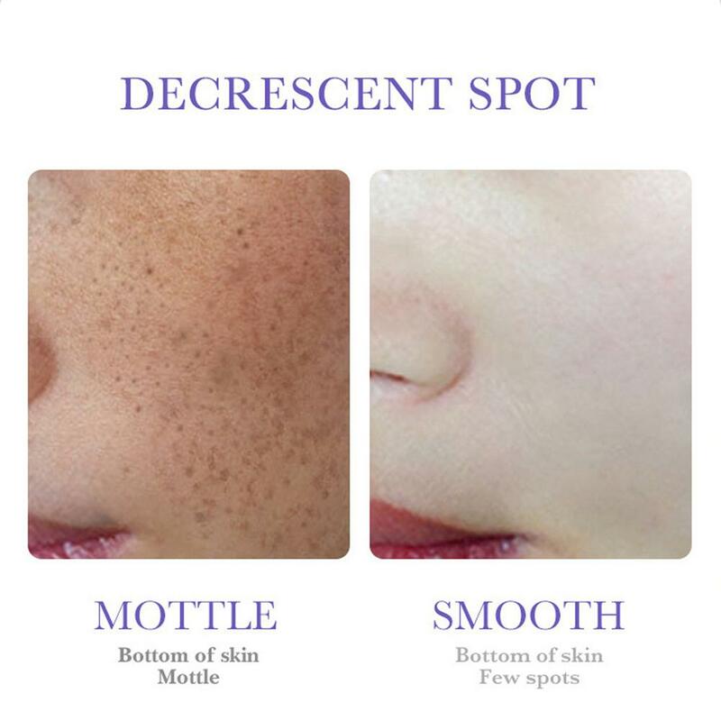 1/2/3/5pcs 20g Nicotinamide Whitening Freckles Cream Remove Melasma Dark Spot Acne Marks Brightening Skin Tone Face Skin Care