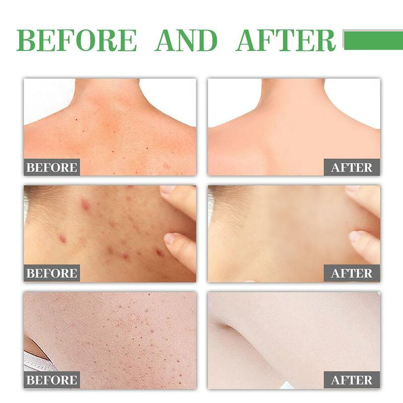 30ml rimozione dell'acne siero viso erbe trattamento dell'acne rimozione dei brufoli ridurre i pori controllo dell'olio viso erbe Acne cura della pelle